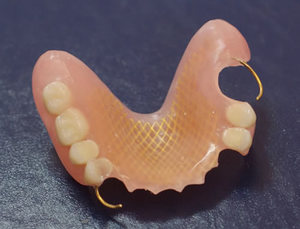 Teilprothese