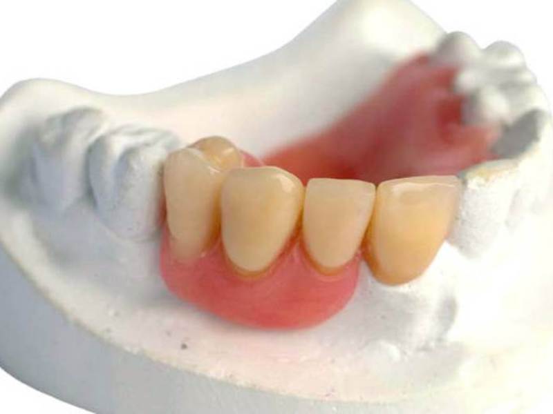 Abnehmbare Prothese aus Acryl