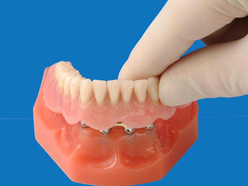 Implantatprothese