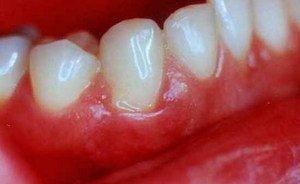 Der Preis von Dentalkleberpaste Solcoseryl