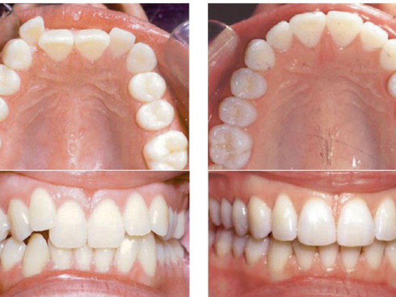 Ivisalign Zahnspange Ergebnis