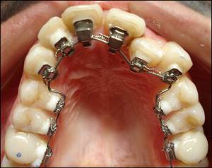 Interne Zahnspange Stb