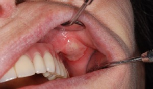 Der Nachweis von Stomatitis ist recht einfach, ausreichend Sichtprüfung.