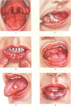 Die Stomatitis stoppt möglicherweise an verschiedenen Stellen.