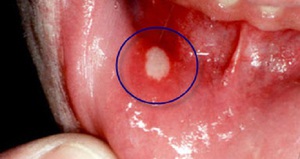 Aphta genannt Geschwüre, die während der Stomatitis auftreten.