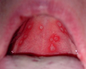 Stomatitis kann sich in der Zunge manifestieren.